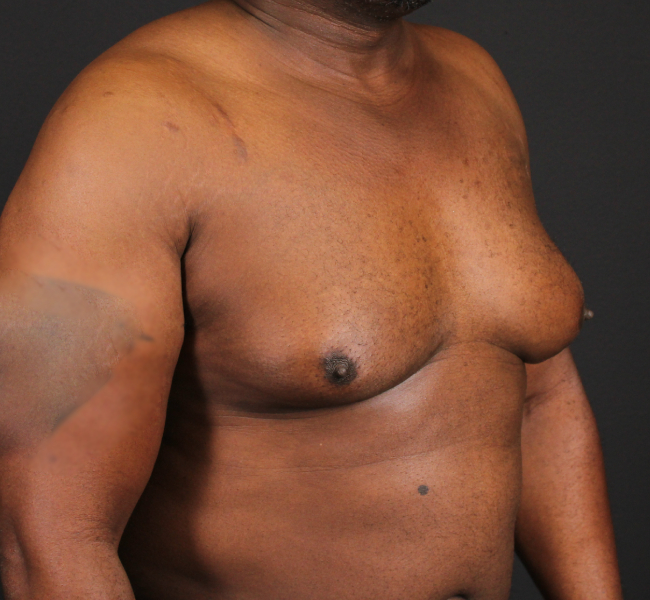 before gynecomastia surgery right angle view case 5025