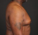 before gynecomastia surgery right side view case 5025
