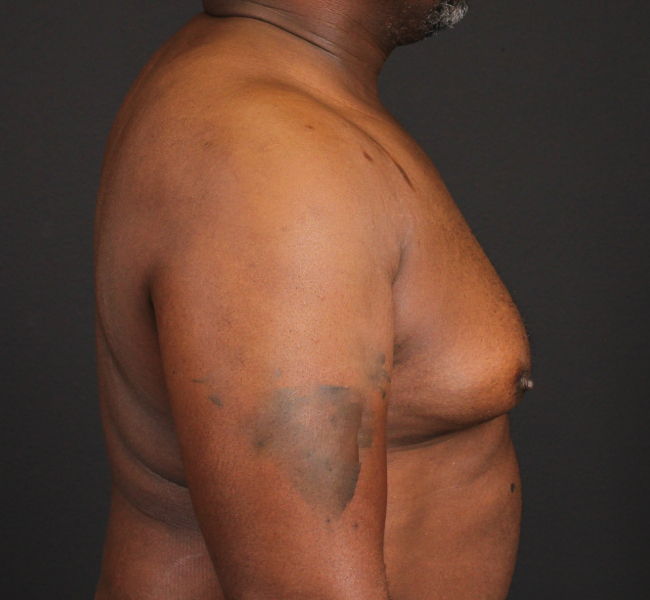 before gynecomastia surgery right side view case 5025