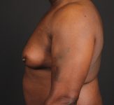 before gynecomastia surgery left side view case 5025