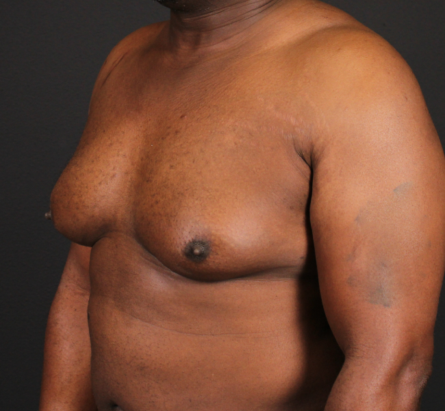 before gynecomastia surgery left angle view case 5025