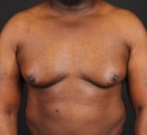 before gynecomastia surgery front view case 5025