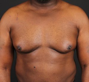 before gynecomastia surgery front view case 5025