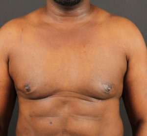 after gynecomastia surgery front view case 5025