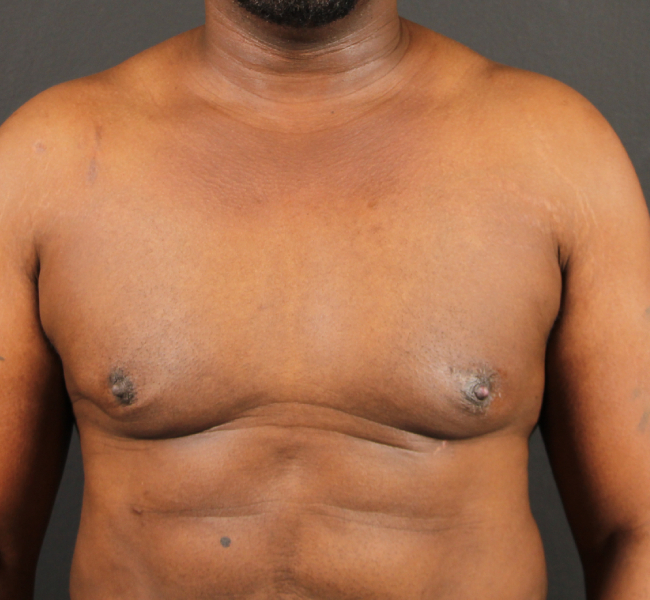 after gynecomastia surgery front view case 5025