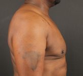 after gynecomastia surgery right side view case 5025