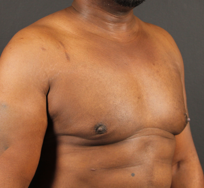 after gynecomastia surgery right angle view case 5025