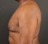 after gynecomastia surgery left side view case 5025